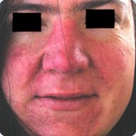 Acne-Rosacea Acne-Rosacea