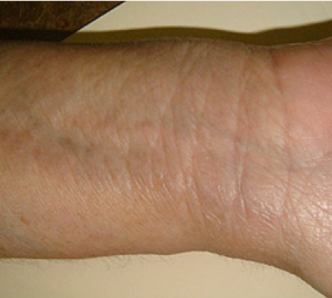 Eczema After Treatment