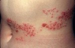 Herpes-Zoster-e1365955667744 Herpes-Zoster-e1365955667744