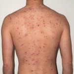 Male-acne-back-CFP-Oct14-jpg-150x150 Chinese medicine is used<br/> to treat adult acne at the<br/> Skin Clinic in Dublin.