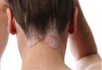 Sebborrheic-Dermatitis-e1365955469611 Sebborrheic-Dermatitis-e1365955469611