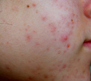 Teenage-Acne Teenage-Acne
