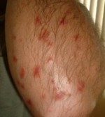 Guttate-Psoriasis-e1365955732139