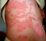 Plaque-Psoriasis-e1365955526766