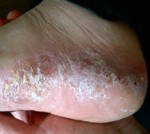 Pustular-Psoriasis-e1365955506410